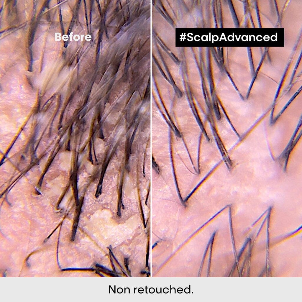 LOreal Serie Expert Scalp Advanced Anti-Dandruff Shampoo Before & After