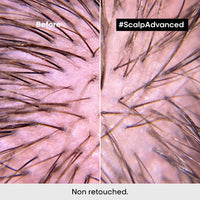 HairMNL L'Oreal Serie Expert Scalp Advanced Anti-Discomfort Before & After